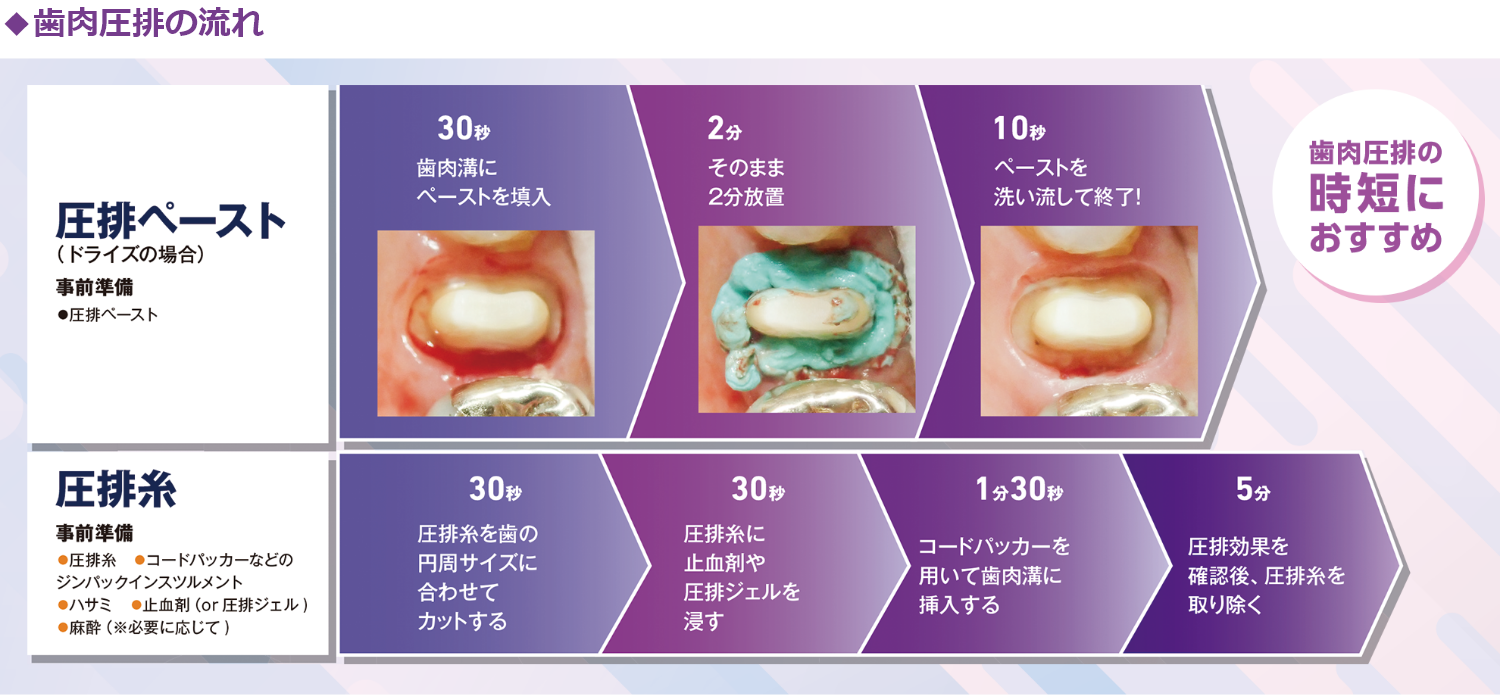 歯肉圧排の流れ