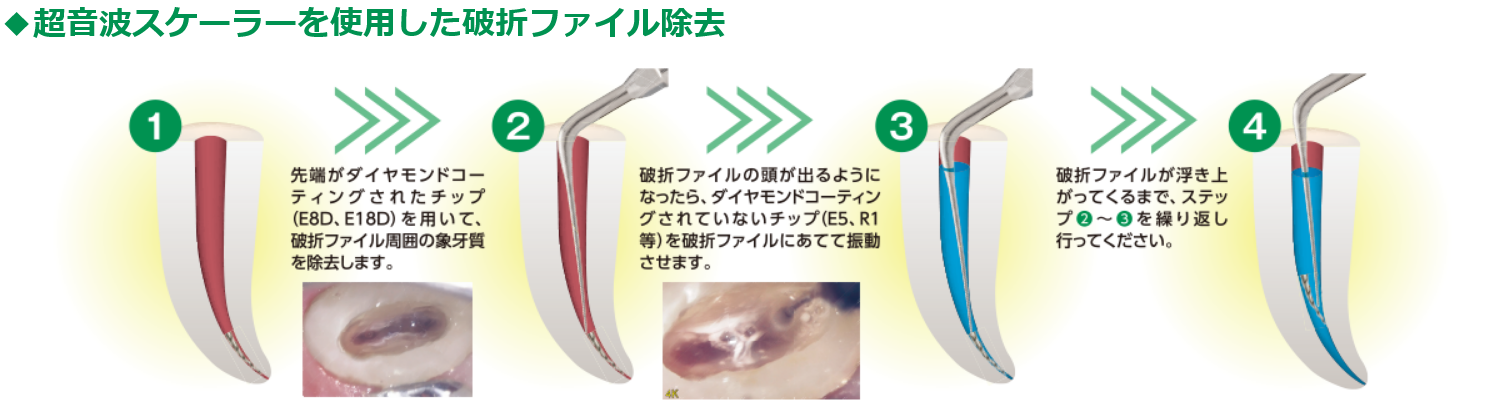 超音波スケーラーを使用した破折ファイル除去