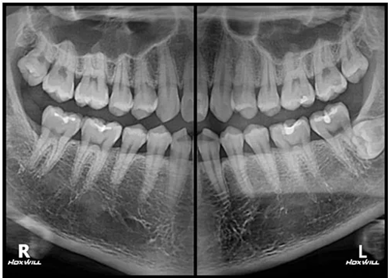 バイトウィング撮影の画像