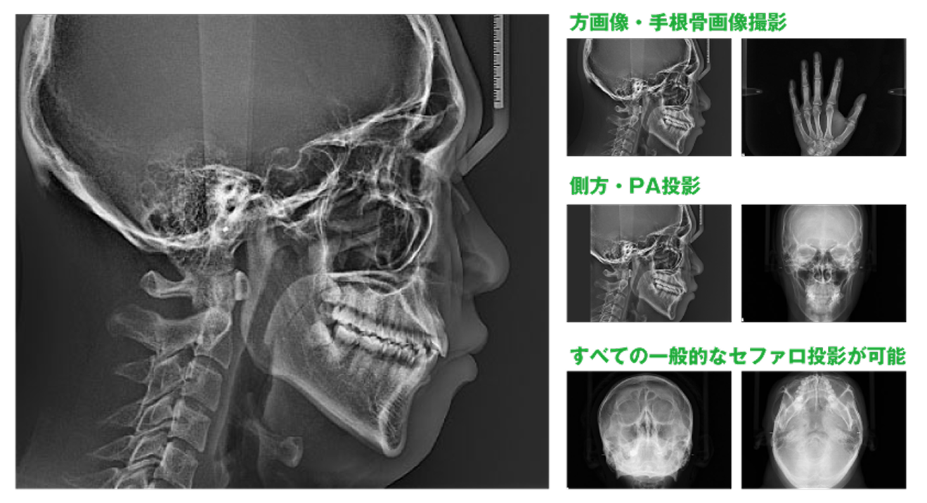 セファロ撮影の画像