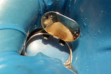 根管孔を確認しながら治療が可能