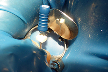 上顎臼歯部の視認性が向上