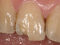 歯質に高い接着力をもつプレリュードワン_1