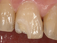 歯質に高い接着力をもつプレリュードワン_2