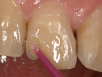 歯質に高い接着力をもつプレリュードワン_3