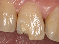 歯質に高い接着力をもつプレリュードワン_4