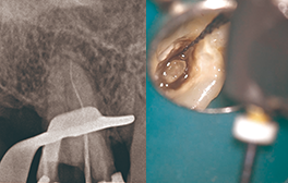 エッジテーパープラチナムを使用