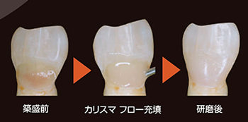 軽度着色歯にフローだけで対応可能。