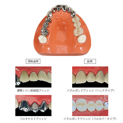 ○　ヒューマンブリッジ　サンプル模型人工歯　メタルボンド　維持装置　ゴールド ヒューマンブリッジ - 【公式】和田精密歯研株式会社