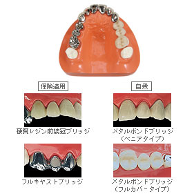 フィード ブリッジ対比模型