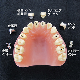 リアルモデルA 単冠補綴 保険・自費比較