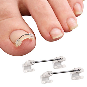 巻き爪ワイヤーガード